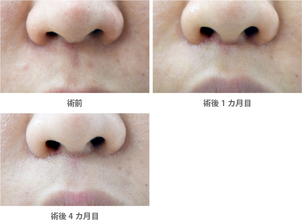 「人中短縮後の傷跡①/筋肉・ASN処理あり」の症例写真・ビフォーアフター
