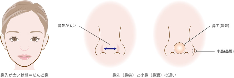 鼻先が太い状態＝だんご鼻・鼻先（鼻尖）と小鼻（鼻翼）の違い