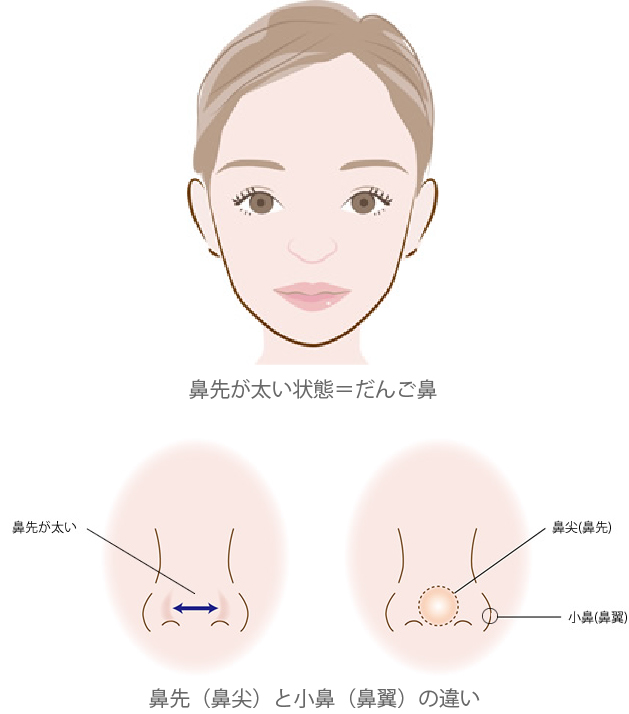 鼻先が太い状態＝だんご鼻・鼻先（鼻尖）と小鼻（鼻翼）の違い