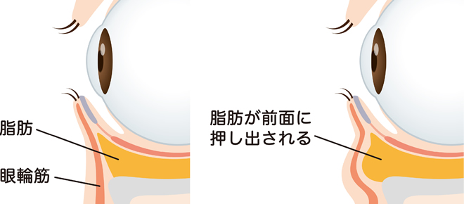 目の下のたるみは眼窩脂肪の下垂が主な原因