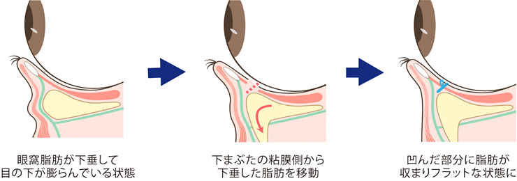 脱脂法（いわゆる「傷跡が残らない目の下のたるみ取り」）