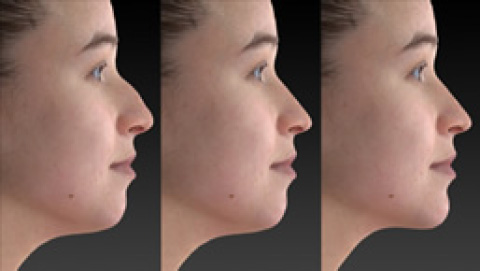 人中短縮・Cカールリップ（ヒアルロン酸注入）