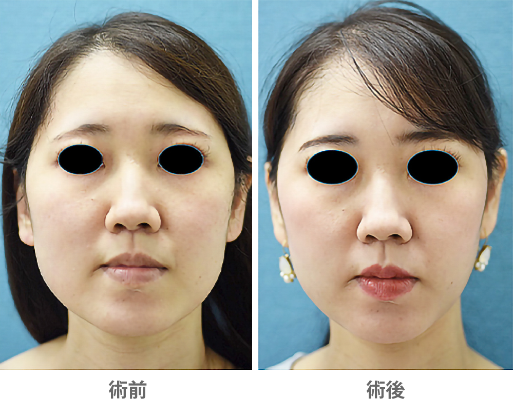 「ジョールファット除去」の症例写真・ビフォーアフター