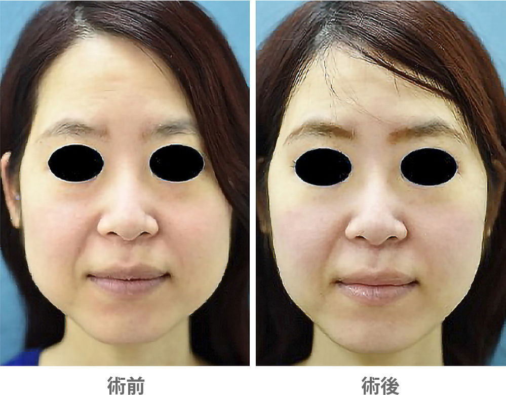 「ジョールファット除去」の症例写真・ビフォーアフター