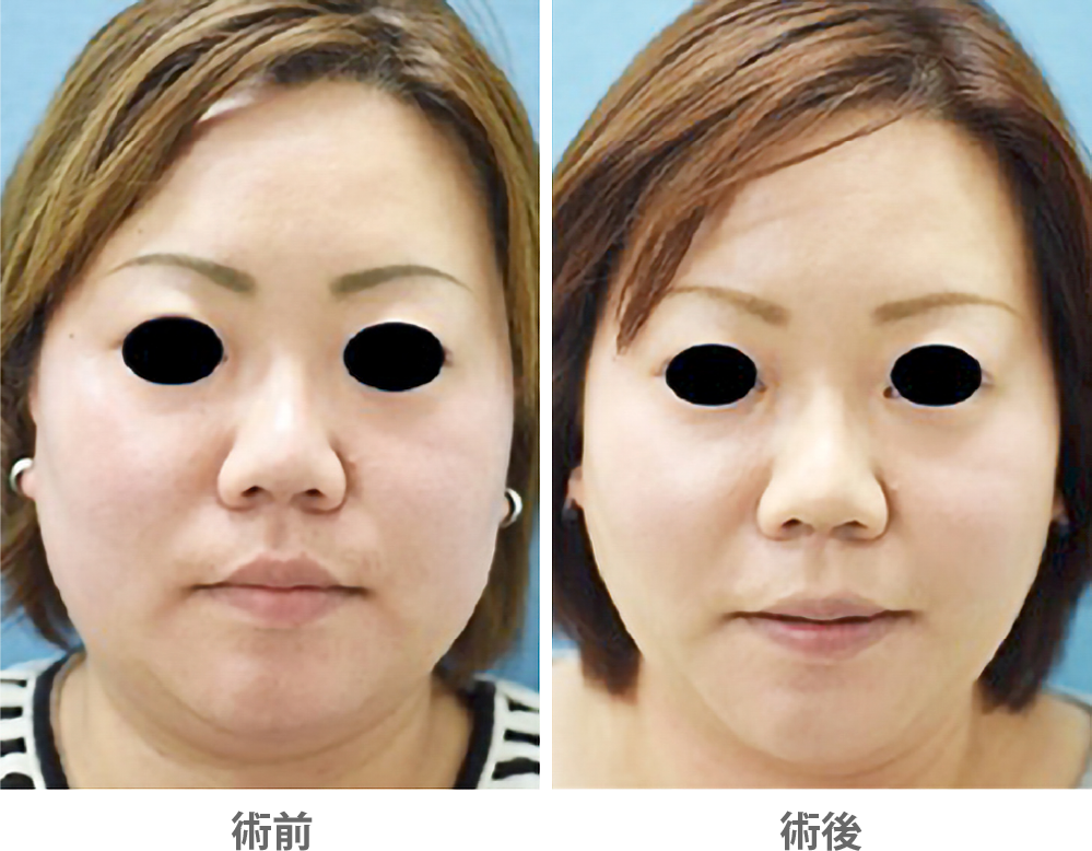 「脂肪除去（ジョールファット＆顎下）」の症例写真・ビフォーアフター