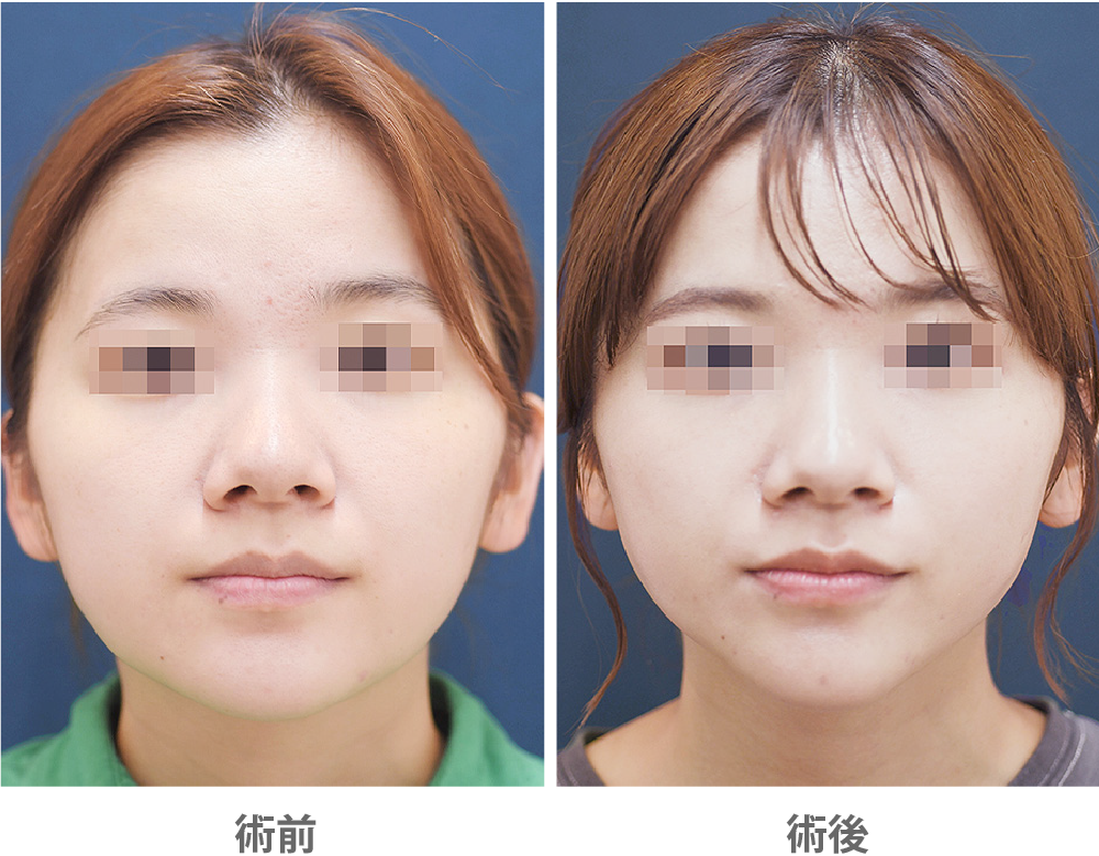 「ジョールファット除去」の症例写真・ビフォーアフター