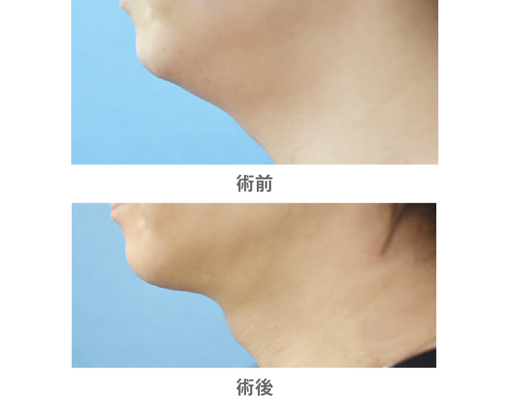 「脂肪除去（ジョールファット＆顎下）」の症例写真・ビフォーアフター