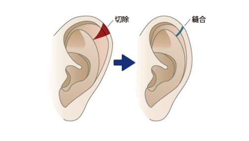 脂肪吸引はリバウンドしにくい