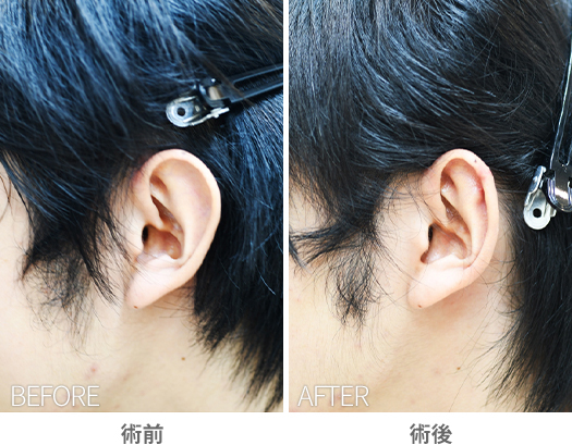 「耳介縮小術（耳輪舟状窩切除法）」の症例写真・ビフォーアフター