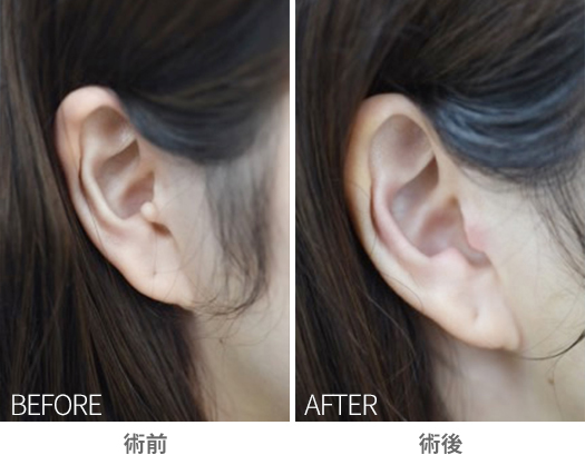 「副耳切除（耳珠／トラガスの突起除去）」の症例写真・ビフォーアフター