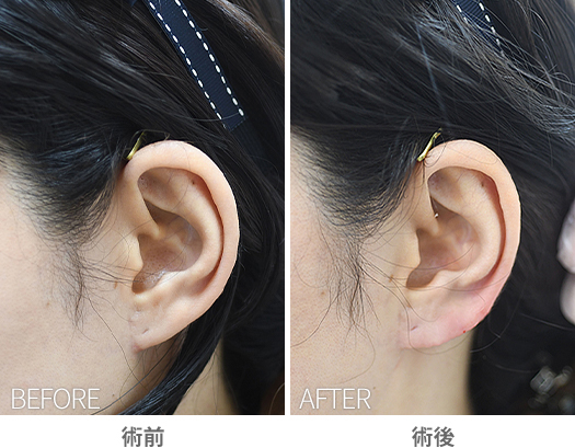 「耳垂ヒアルロン酸注入（耳たぶの幅を広げる）」の症例写真・ビフォーアフター
