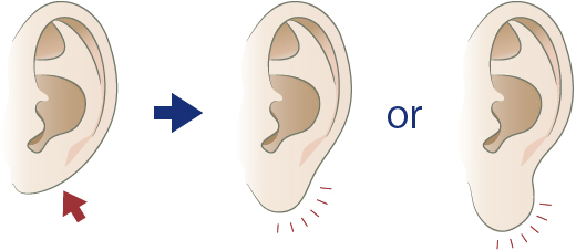 頬・顎下なら30分ほどで終了