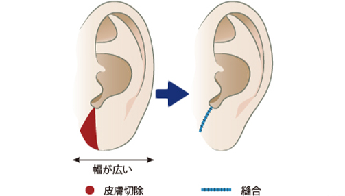 頬・顎下なら30分ほどで終了