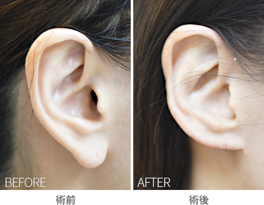 「耳垂縮小術（耳たぶを小さく見せる耳形成術）」の症例写真・ビフォーアフター