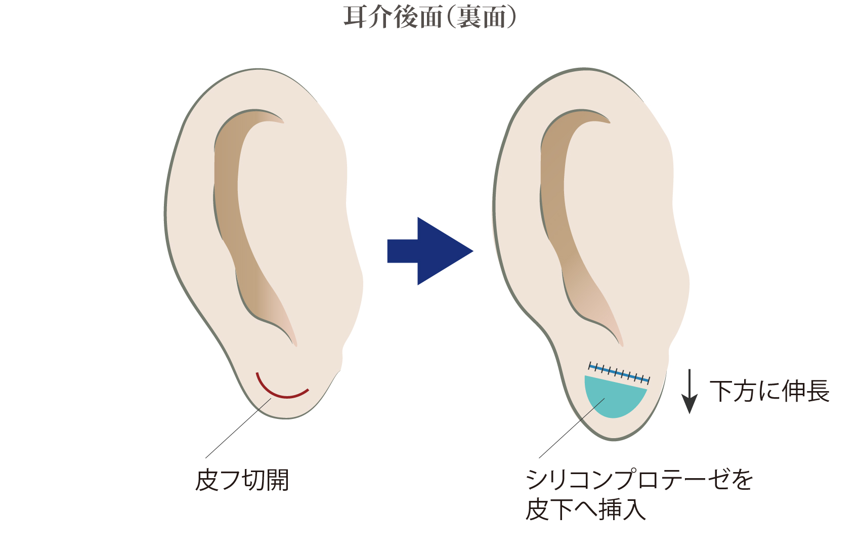 2回目以降の手術は必要なし