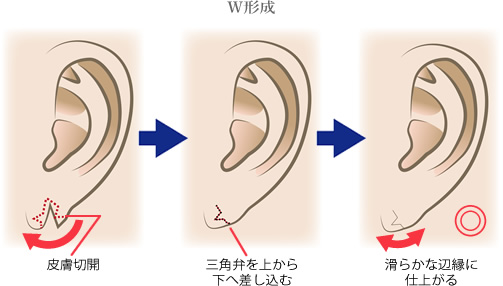 脂肪細胞そのものを除去することが可能