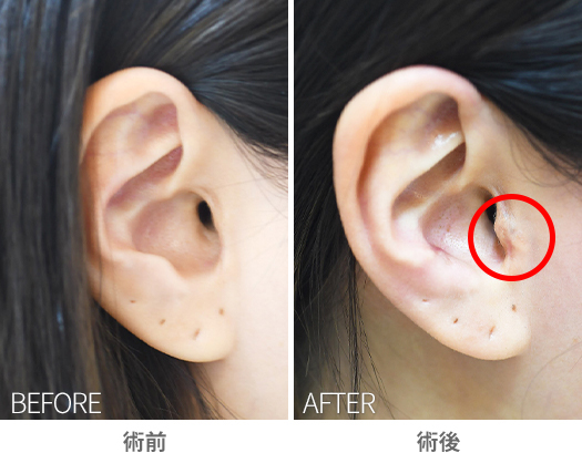 「耳珠（じしゅ）再建手術（鼻整形後の耳珠形成）」の症例写真・ビフォーアフター