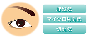 埋没法　マイクロ切開法　切開法