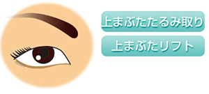 上まぶたたるみ取り　上まぶたリフト