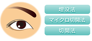 埋没法　マイクロ切開法　切開法