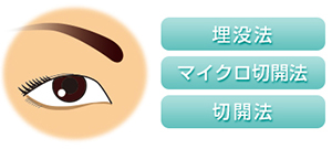 埋没法　マイクロ切開法　切開法