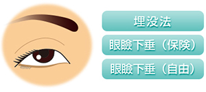 埋没法　眼瞼下垂（保険）眼瞼下垂（自由）