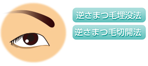 逆さまつ毛埋没法　逆さまつ毛切開法