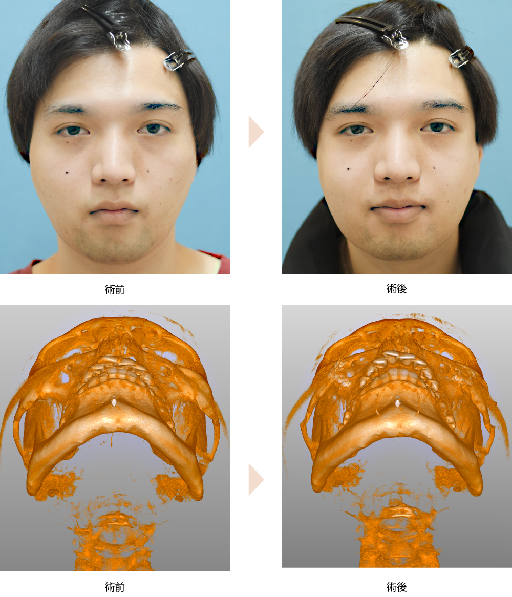 「頬骨整形／頬骨骨切り・骨削り術（顔の横幅を縮めて卵型の小顔に改善）」の症例写真・ビフォーアフター