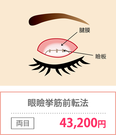 眼瞼挙筋前転法