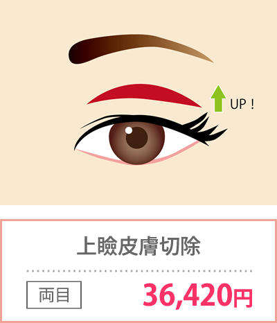 上瞼皮膚切除