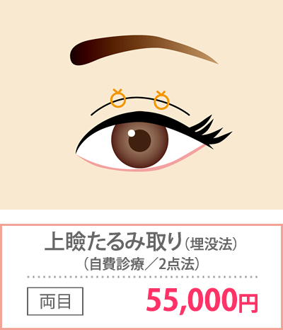 上瞼たるみ取り（埋没法）
