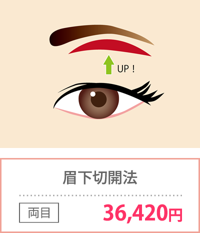 眉下切開法
