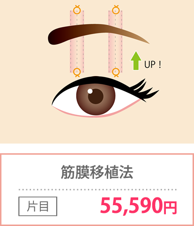 筋膜移植法