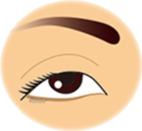 眼瞼下垂治療