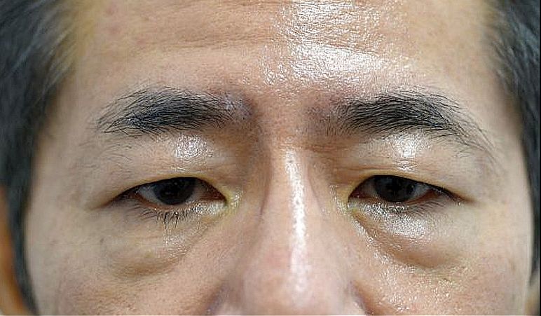 眼瞼下垂治療の症例写真ビフォーアフター