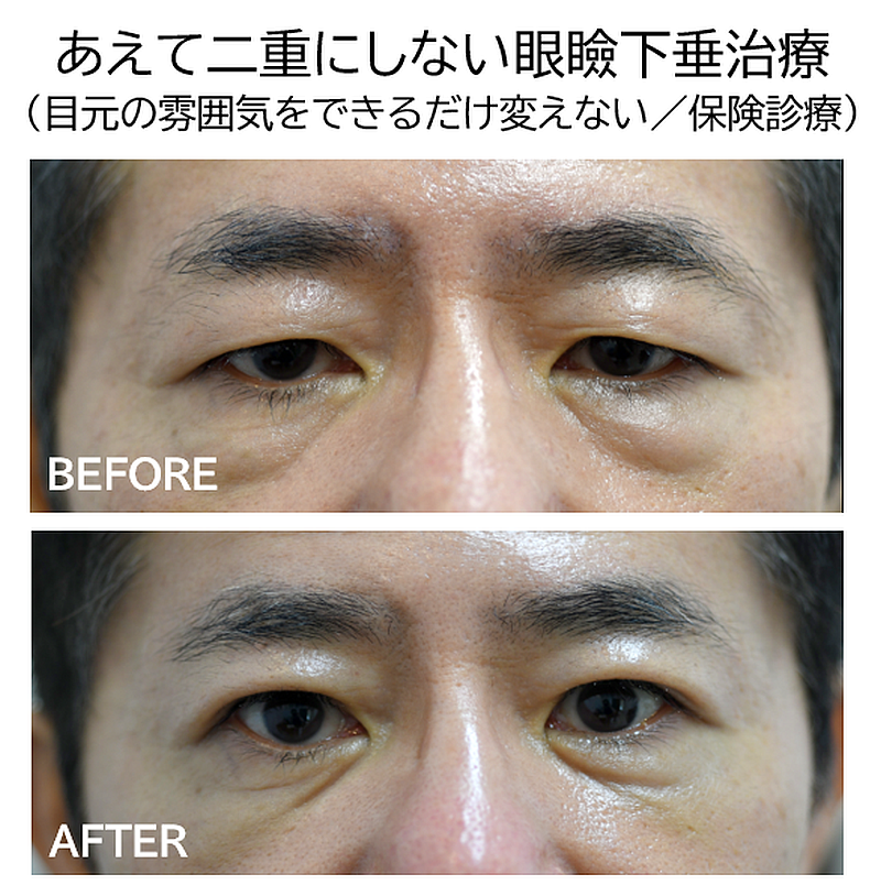 眼瞼下垂治療の症例写真ビフォーアフター