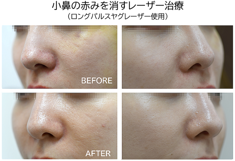 小鼻の赤みを消すレーザー症例写真