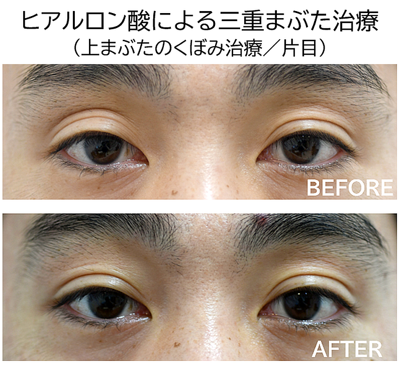 三重まぶた治療の症例写真