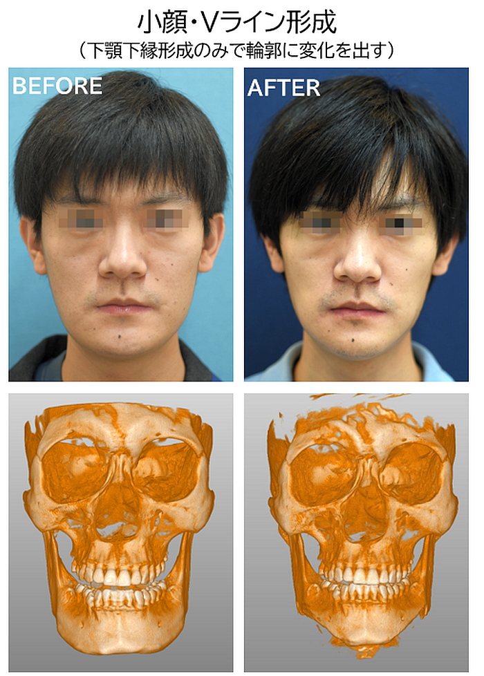 小顔整形の症例写真ブログ