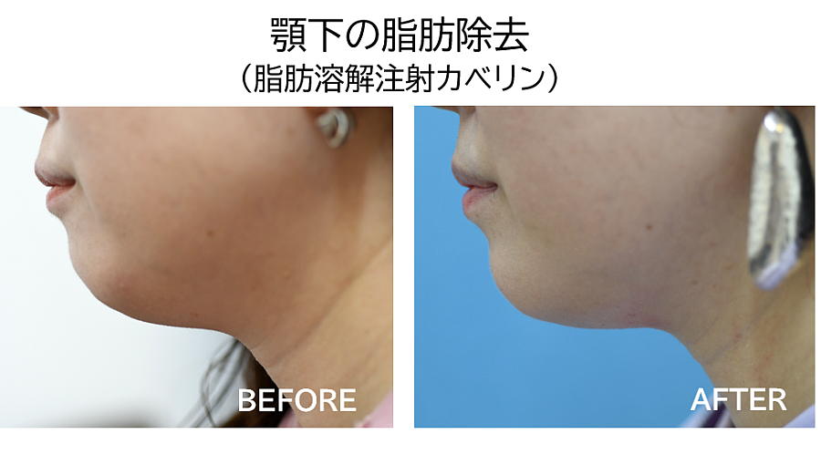 脂肪溶解注射カベリンによるたるみ治療