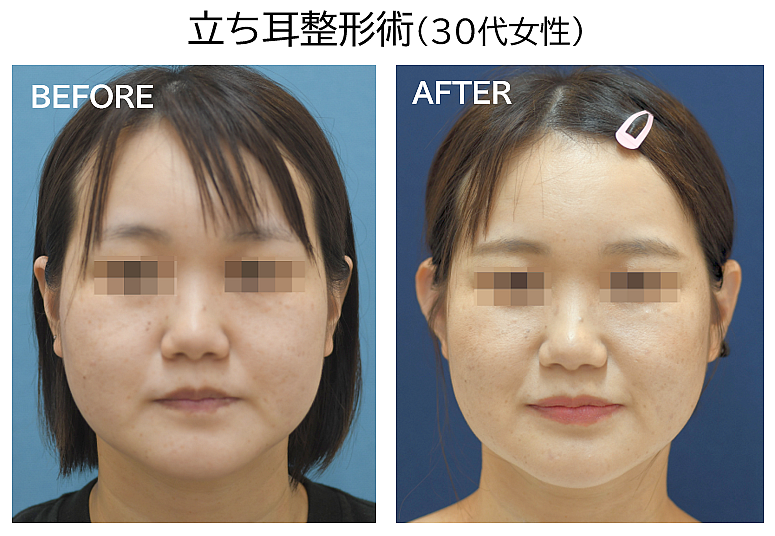 立ち耳整形の症例写真
