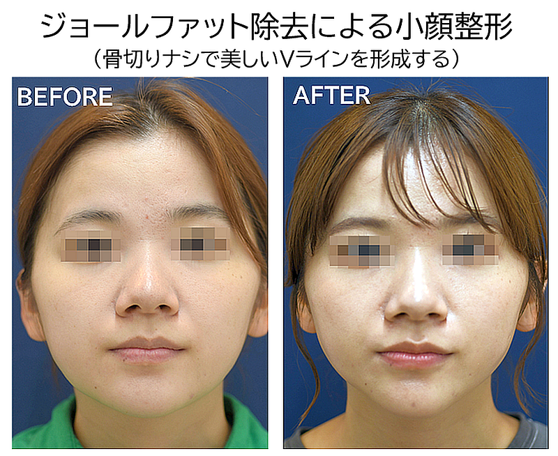 ジョールファット除去の症例写真