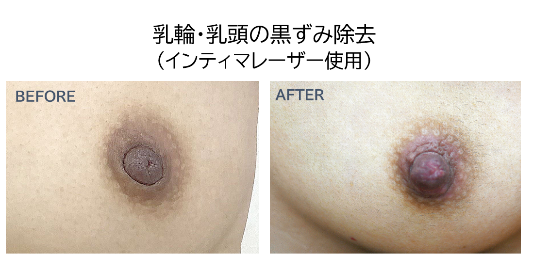 乳輪・乳頭の黒ずみレーザー治療の症例写真