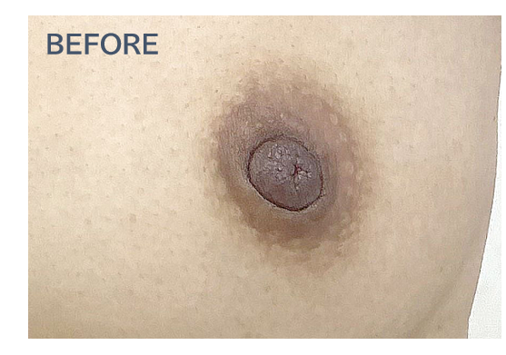 乳輪・乳頭の黒ずみレーザー治療の症例写真