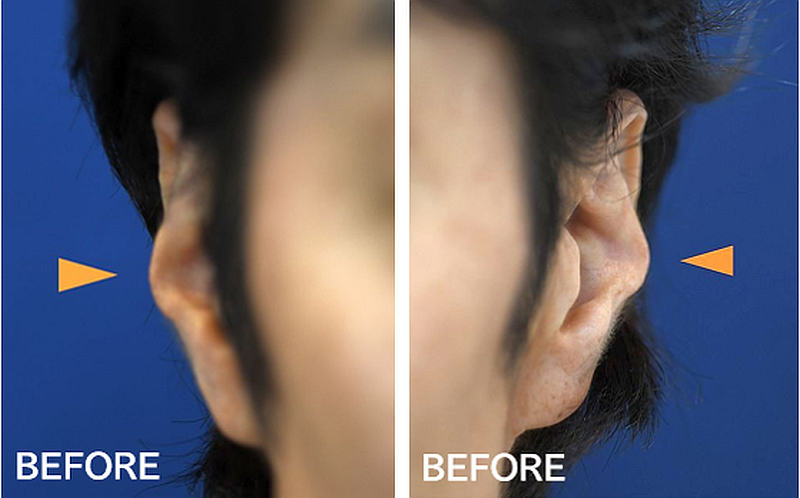 耳の整形の症例写真