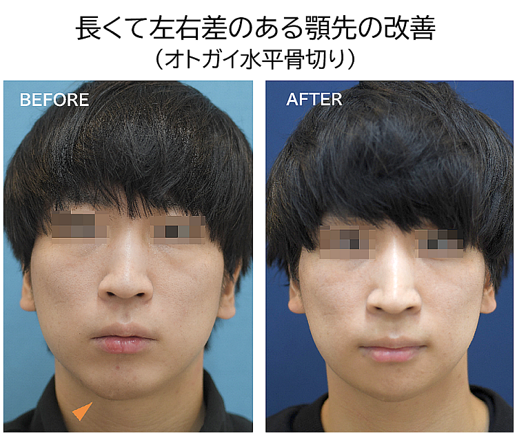 オトガイ形成の症例写真・ビフォーアフター