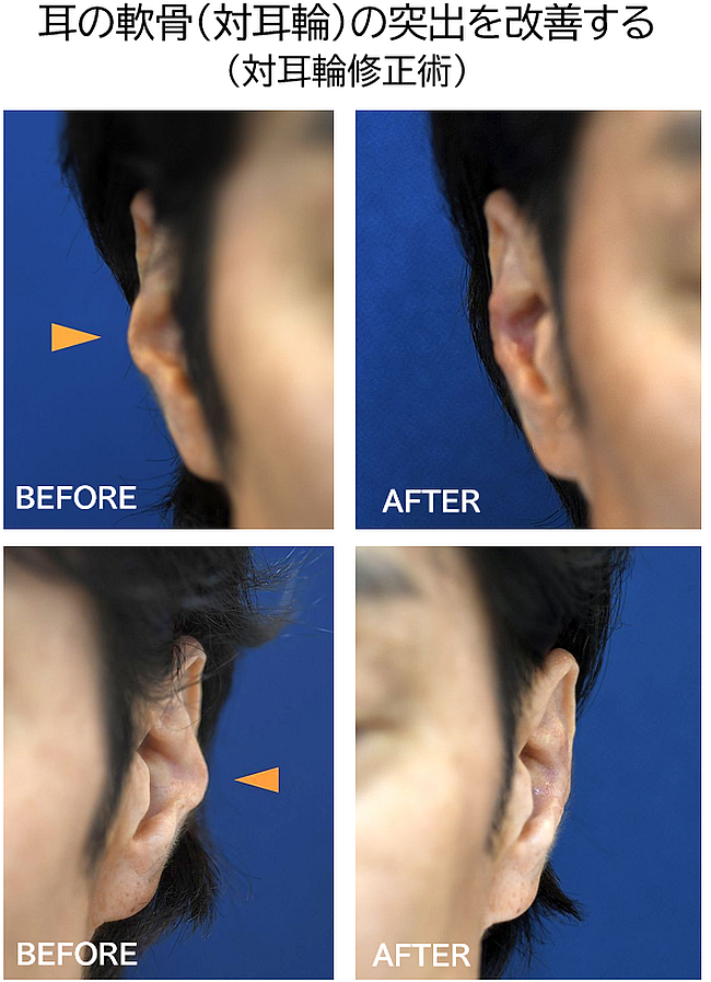 耳の整形の症例写真