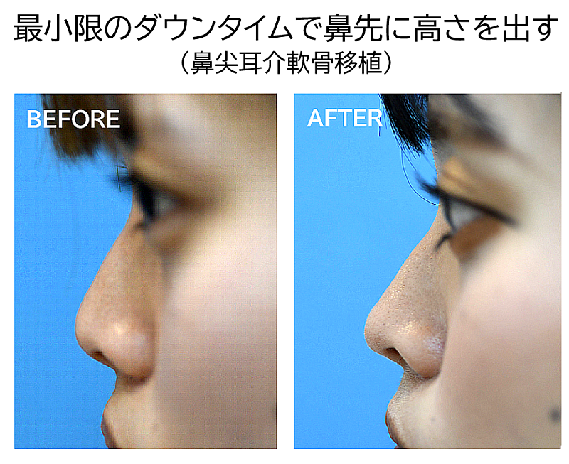 鼻尖形成の症例写真