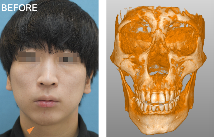 オトガイ形成の症例写真・ビフォーアフター