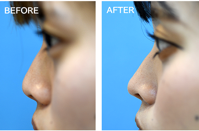 鼻尖形成の症例写真